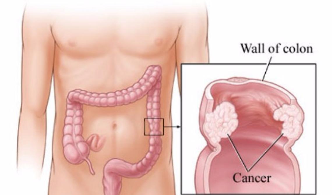 OO.RR., focus sul carcinoma della prostata e del retto