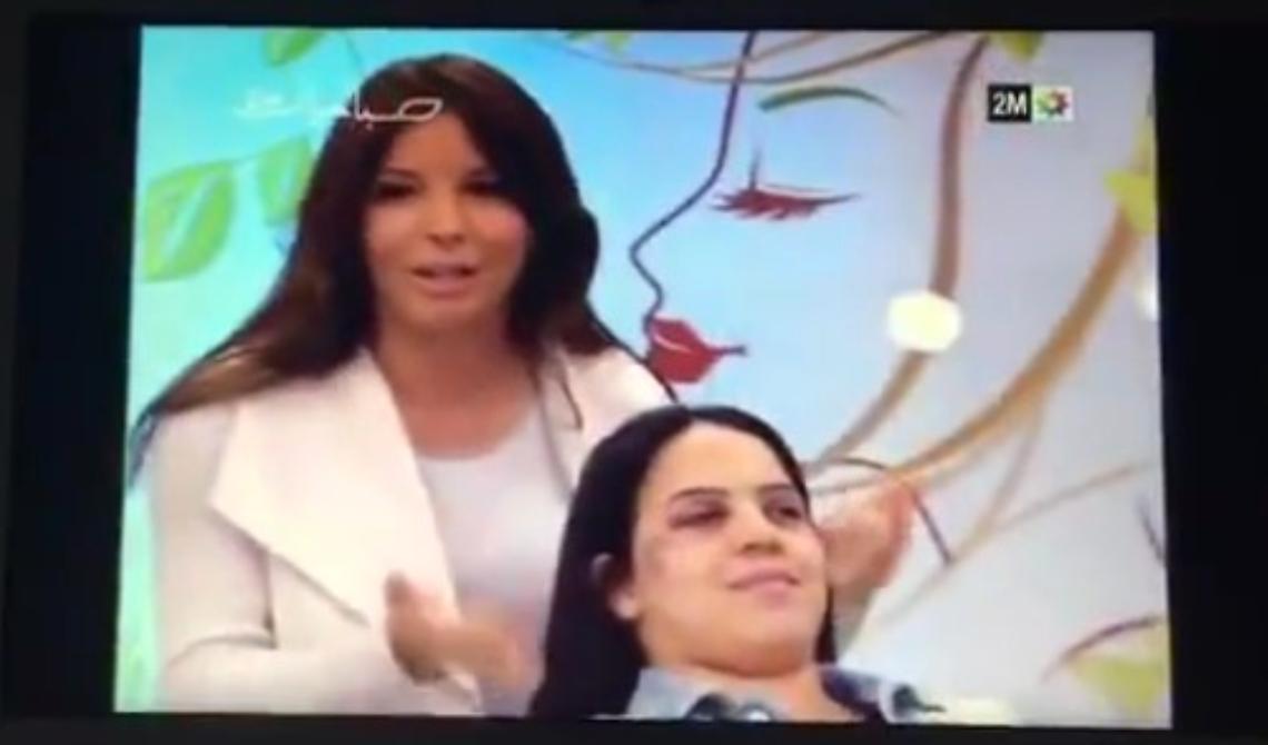 Quei lividi che non vengono via col trucco