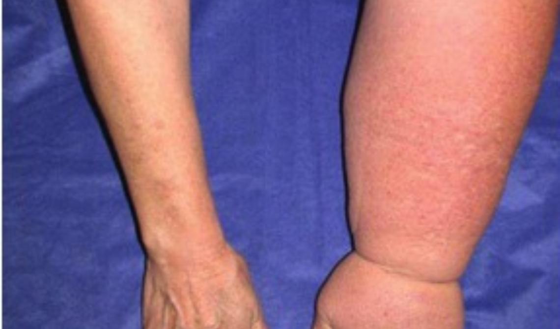 Linfedema, la malattia rara misconosciuta “compressa” dal silenzio