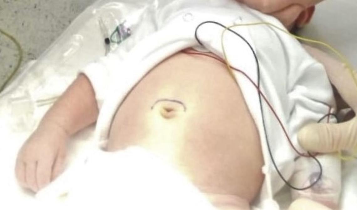 Al San Carlo di Potenza intervento di alta chirurgia neonatale su un paziente di soli 27 giorni
