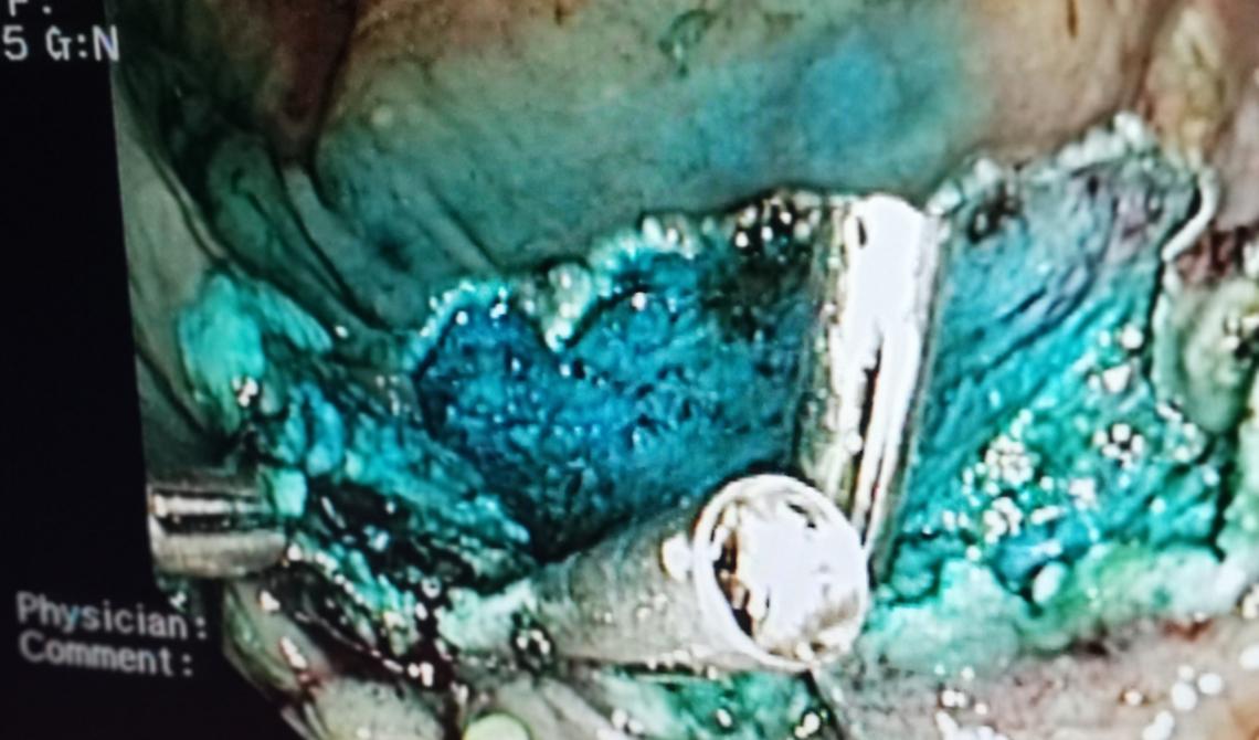 Ospedale di Melfi, eseguito per la prima volta intervento endoscopico innovativo 