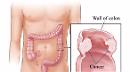 OO.RR., focus sul carcinoma della prostata e del retto
